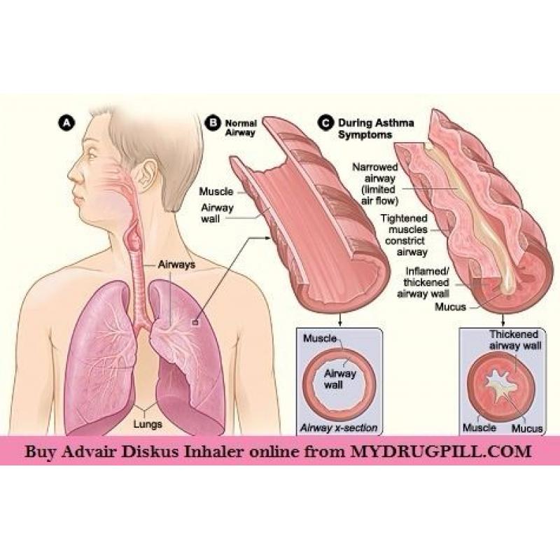 Buy advair diskus Inhaler online for hyperactive airway issues